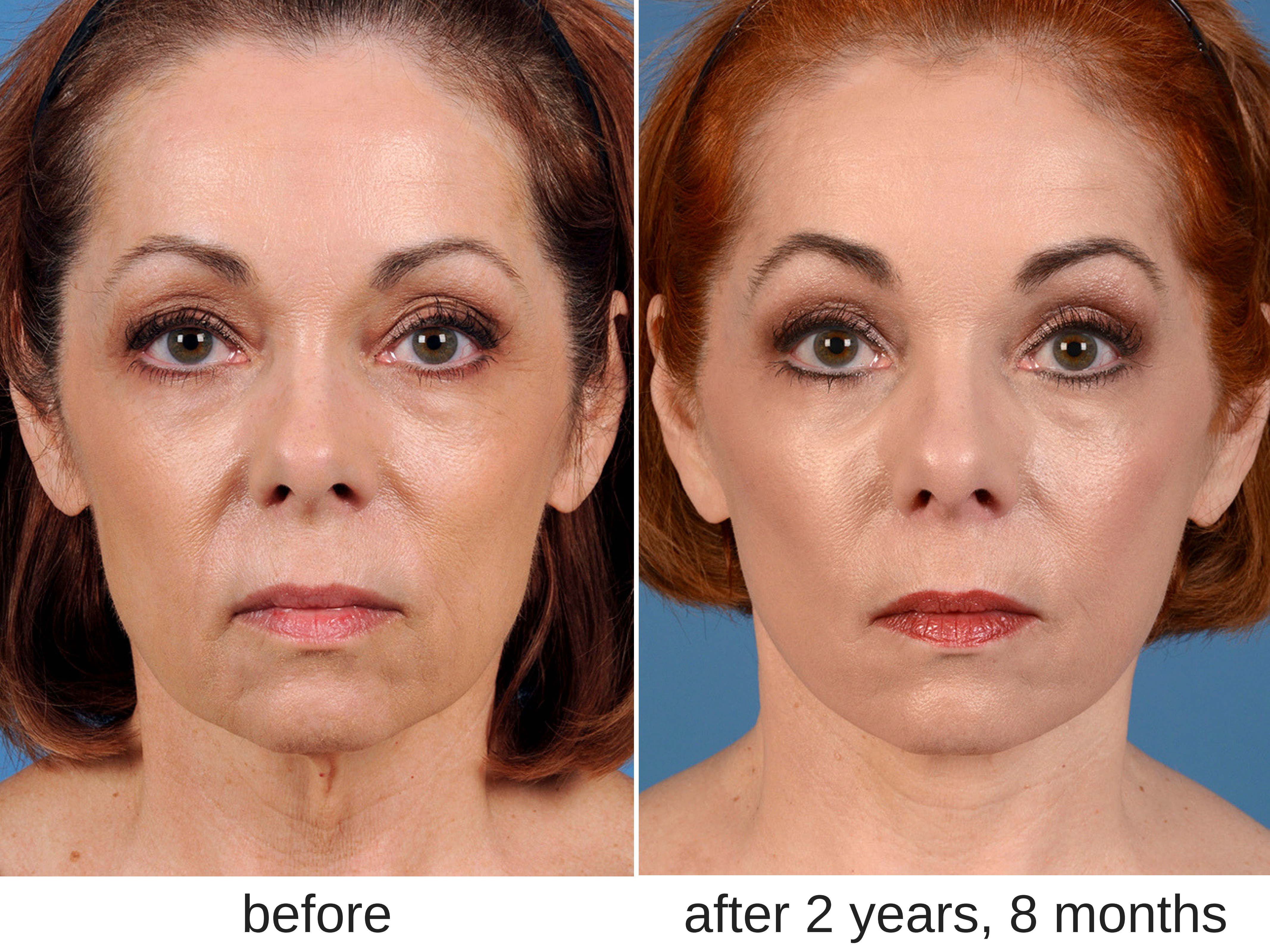 Face the Facts: Improving Facial Appearance with a Natural Look